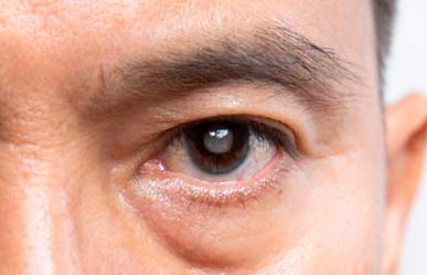 Glaucoma